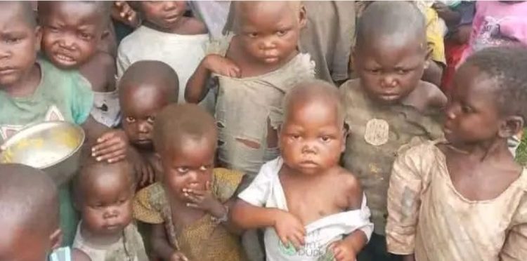 Kamanyola : recrudescence des cas de kwashiorkor chez les enfants.